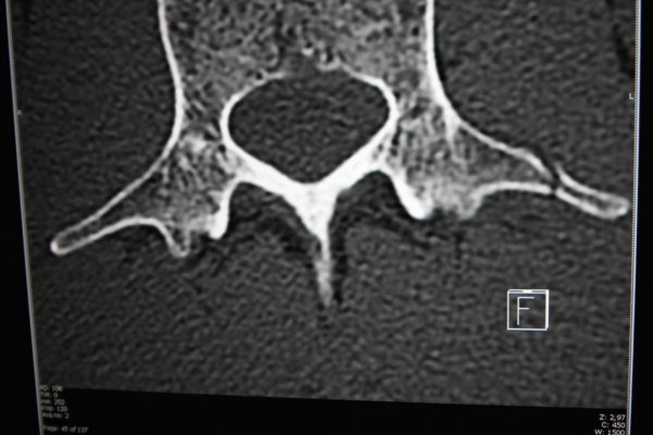 Snmek zlomenho obratle Fabiana Cancellary